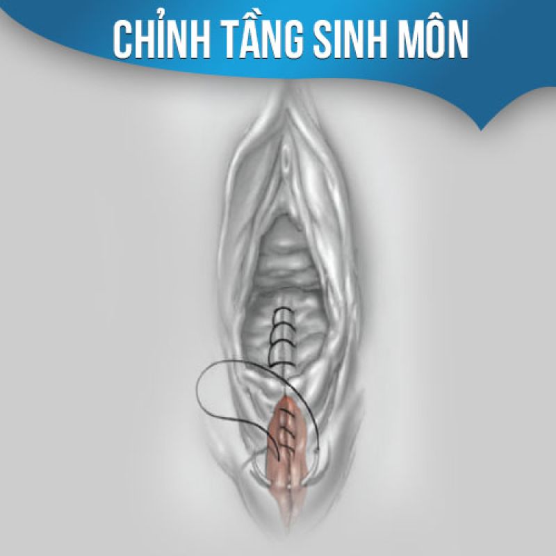 CHỈNH SẸO XẤU TẦNG SINH MÔN